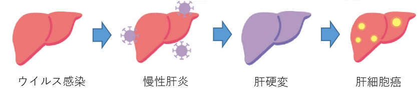 ウイルス性肝炎の分類