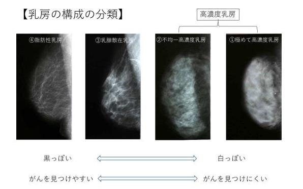 乳房の構成の分類
