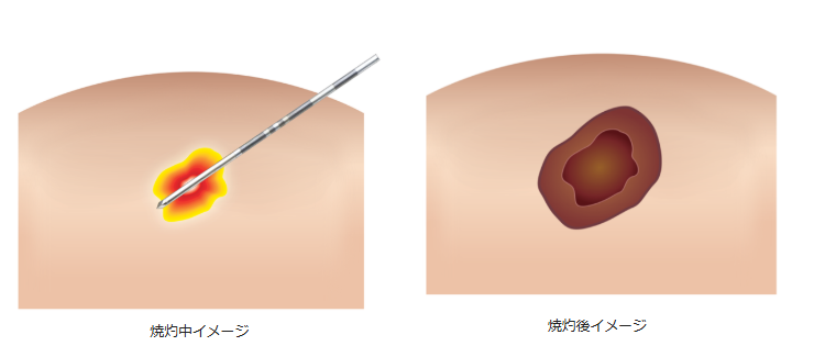 RFA(ラジオ波焼灼療法)